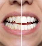 יישור שיניים באמצעות סמכים ממתכת - תמונת אווירה